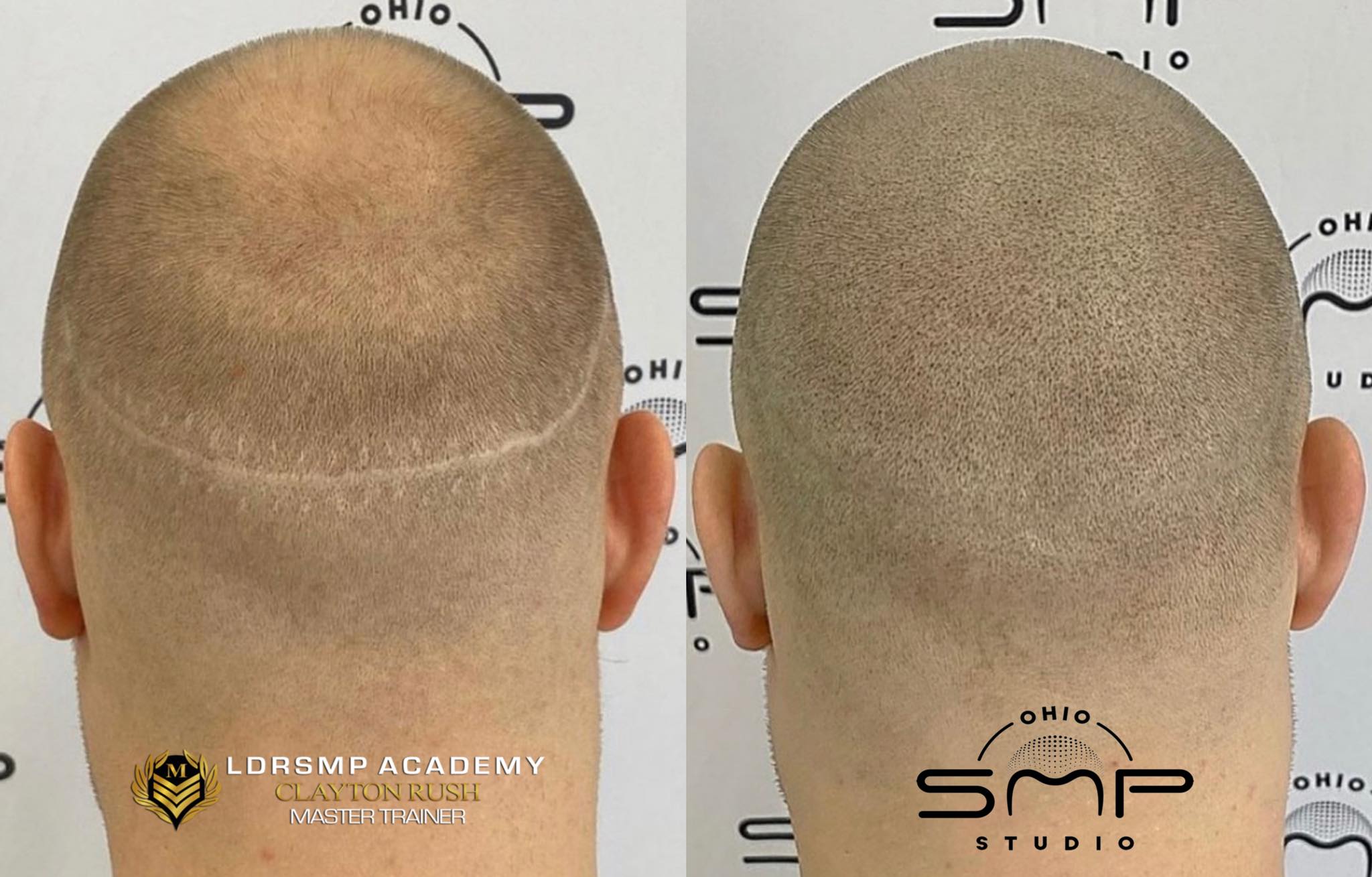 The Confidence Revolution: Scalp Micropigmentation